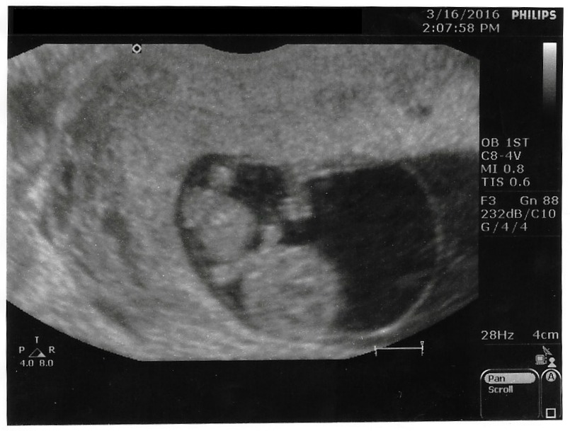 baby #4 at nine weeks